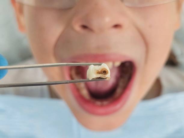 Best Emergency Treatment for Dental Infections or Abscesses in Manawa, WI